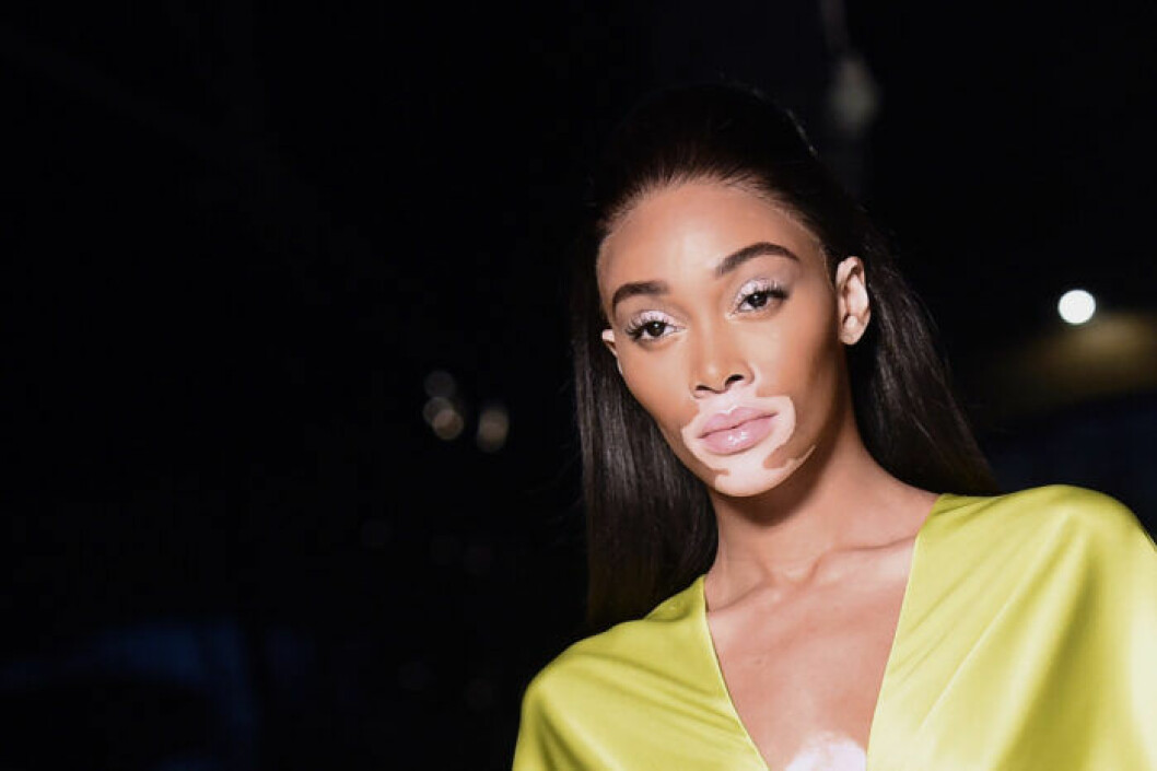 Supermodellen Sinne Harlow har blivit ansiktet utåt för hudåkomman vitiligo. 